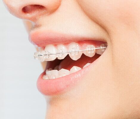 clear fixed braces